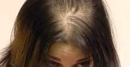 شعري يتساقط ماذا أفعل ؟